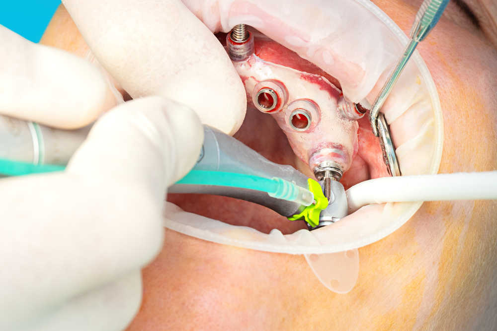 Cirugía guiada en odontología